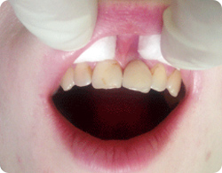 Замещение утраченного зуба коронкой на имплантате