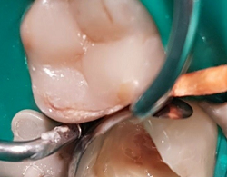 Лечение и функциональная реставрация зуба