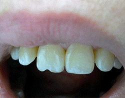 Эстетическая реставрация зуба
