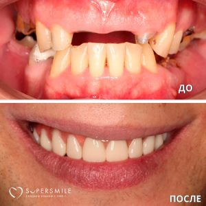 Что лучше – All-on-4, All-on-6 или Zygoma?