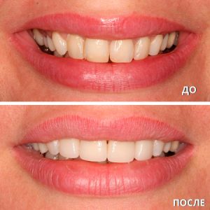 Установка виниров (до/после)