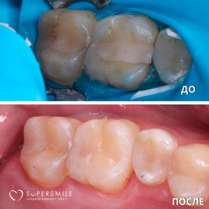 Лечение кариеса (до/после)