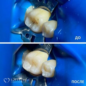 Лечение кариеса (до/после)