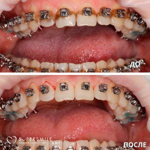 Профессиональная гигиена (до/после)