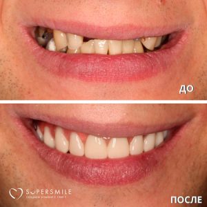 Имплантация All on 6 (до/после)