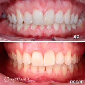 Исправление прикуса (до/после)
