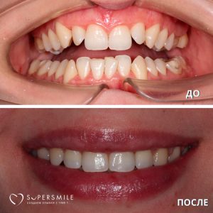 Исправление прикуса (до/после)