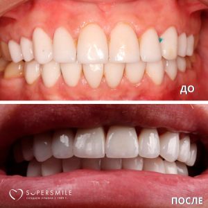 Установка виниров (до/после)