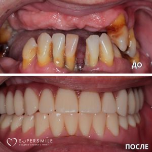 Имплантация/протезирование (до/после)