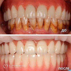 Имплантация/протезирование (до/после)