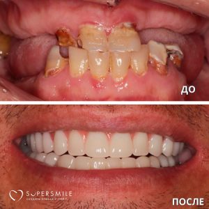 Имплантация/протезирование (до/после)