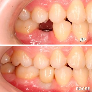 Имплантация/протезирование (до/после)