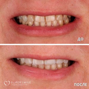 Имплантация/протезирование (до/после)