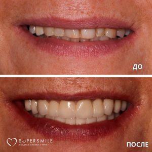 Имплантация/протезирование (до/после)