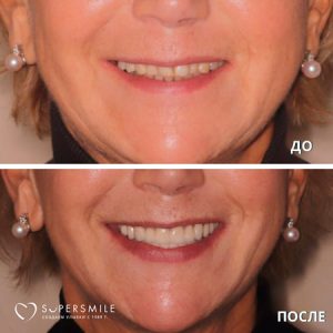 До/После №12666