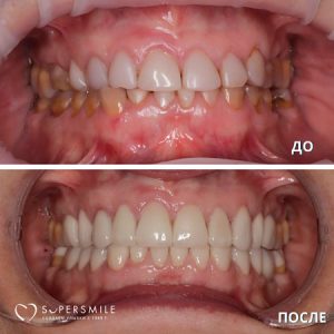 Установка виниров (до/после)