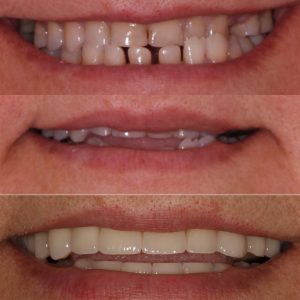 Имплантация/протезирование (до/после)