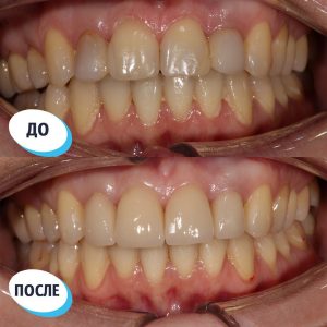 Имплантация/протезирование (до/после)