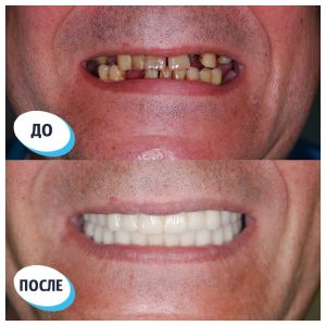 Имплантация/протезирование (до/после)