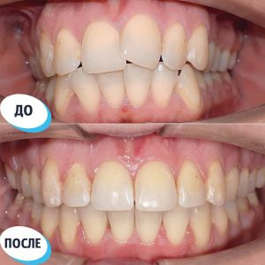 Исправление прикуса (до/после)