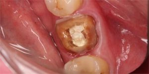 Сохранение зуба.