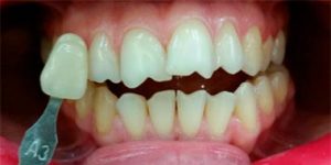 Коррекция формы зуба.