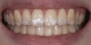 Некариозные поражения эмали.