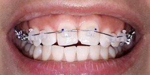Лечение брекет-системами.