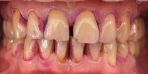 Пародонтит