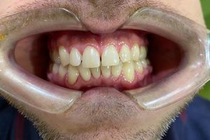 Не только эстетика. Почему нужно исправлять мезиальный прикус?