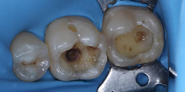 Кариес.