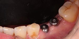 Частичное отсутствие зубов.