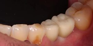 Не идеал: когда ровные зубы выглядят некрасиво