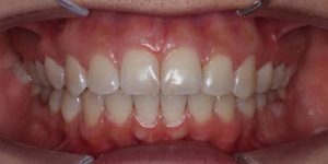 Выбираем лигатурные брекеты: их преимущества