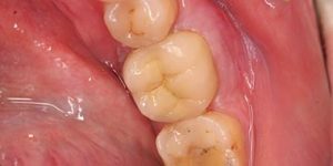 Постановка коронки.