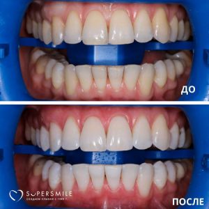 Кабинетное отбеливание Opalescence: быстрый путь к белоснежной улыбке