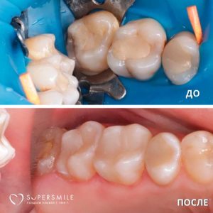 До/После №6525