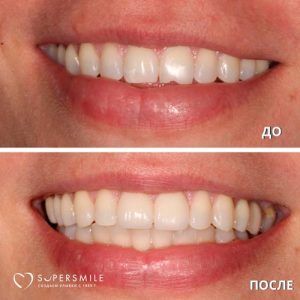 До/После №6806