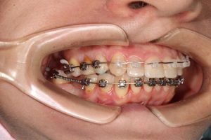 Сколько нужно носить элайнеры?