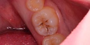 Скол или трещина режущего края.