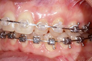 Удаляют ли зубы мудрости перед брекетами?