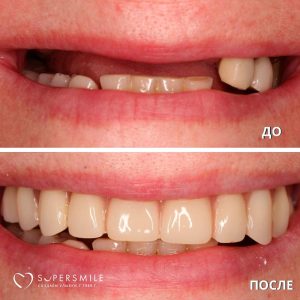 До/После №8213