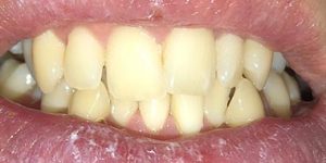 Дистопия или неправильное положение зубов. 