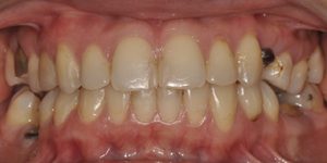 Отсутствие соседних зубов