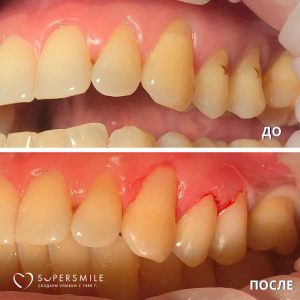 До/После №7893