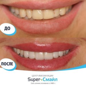 До/После №8392