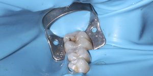 Пародонтит