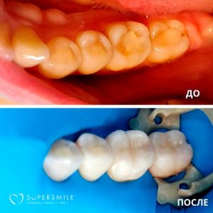 До/После №6433