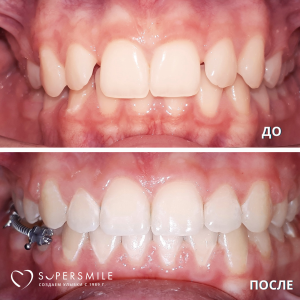 Исправление прикуса (до и после)