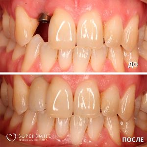 До/После №7468